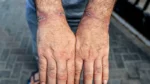 A detainee shows injuries to his wrists after his release back into Gaza